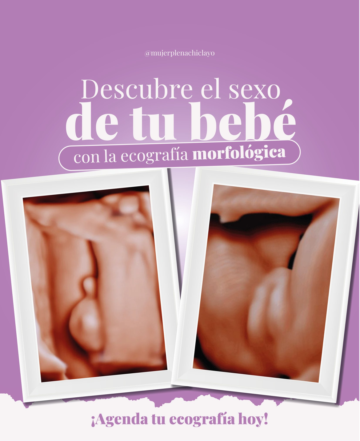 Ecografía ginecológica en Chiclayo